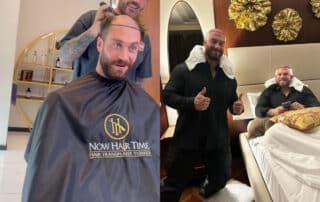 Chris Bumstead Hair Transplant