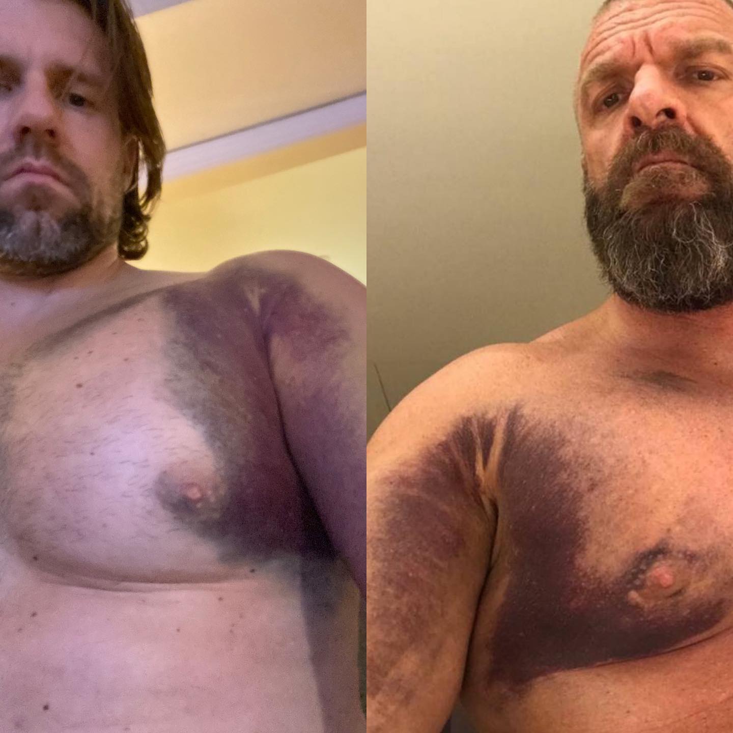Matthew Sonak vs Triple H Torn Pectoral Muscle