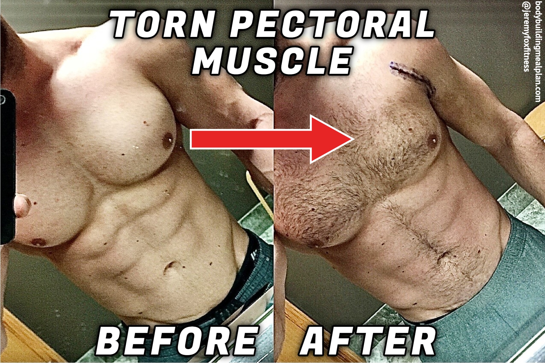 Torn Pectoral Muscle